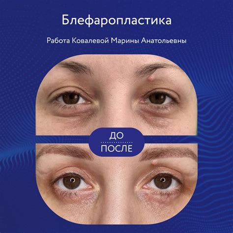 Блефаропластика Кемерово