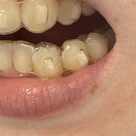 Canine not tracking : r/Invisalign