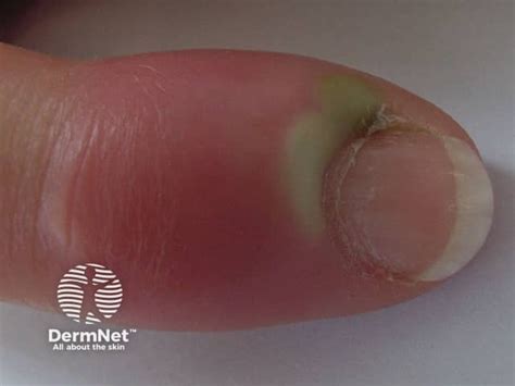 paronychia nail fold infection  images treatment