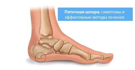 Пяточная шпора [симптомы и лечение, причины появления]