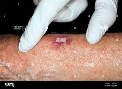 Purpura human -Fotos und -Bildmaterial in hoher Auflösung – Alamy