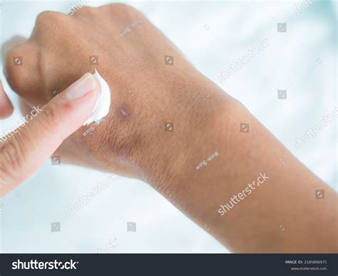 Scar On Hand Woman Finger Applying Stock Photo 2185806975 | Shutterstock