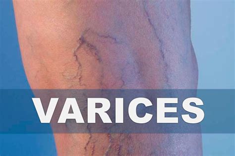 ¿Te molestan las varices? Sepa cómo eliminarlas de forma natural ...