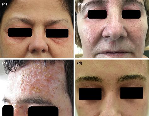 dermatitis in face 1