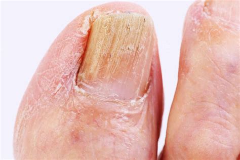 Nail Fungus: The Connection with Athlete's Foot - Well Heeled Podiatry