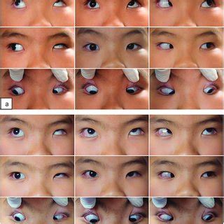 9-gaze photographs of the patient. (a) 9-gaze preoperative photographs ...