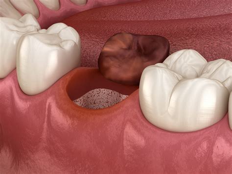 How To Avoid Dry Socket After An Extraction – Everything You Need To ...