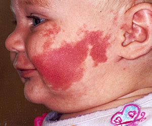 Tertiary Skin Lesions Flashcards | Quizlet
