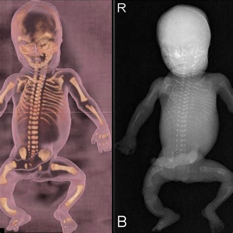 (PDF) Skeletal dysplasia with bowing long bones: Proposed flowchart for ...