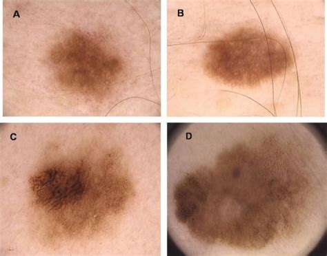 Is Severe Dysplastic Nevus Melanoma - Infoupdate.org