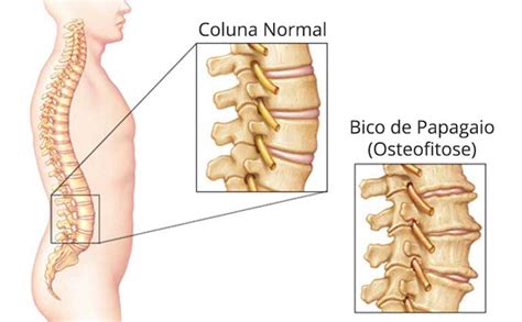 Como É Conhecido Popularmente A Osteofitose - Bico de Papagaio ou Osteofitose - Coluna SP
