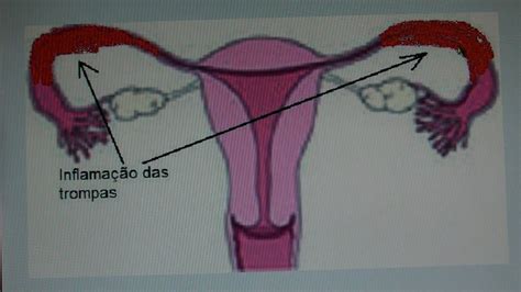 Onde Fica As Trompas Da Mulher - Inflamaçâo das trompas.MP4 - YouTube