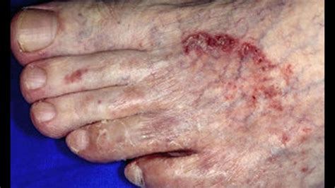 Evaluación de la eficacia del tratamiento farmacológico para la tiña ...