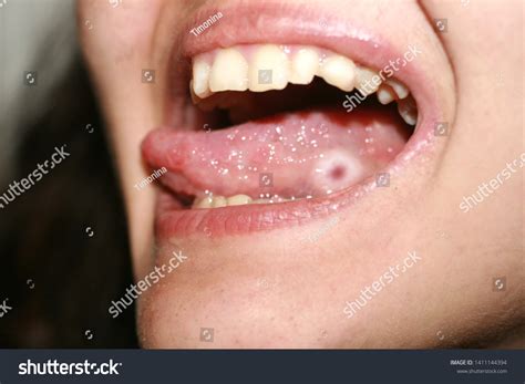 13,247 Spots On Tongue Images, Stock Photos & Vectors | Shutterstock