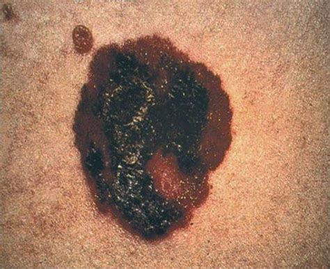 Sinais Escuros Na Pele - 5 sinais e sintomas de câncer de pele (melanoma e não-melanoma)