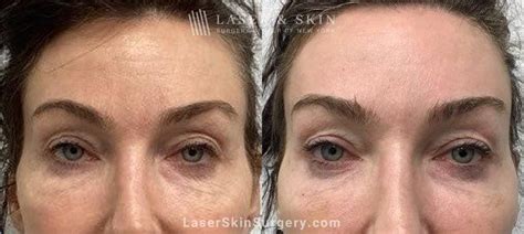 Mohs Surgery Before After Photos - Laser NY