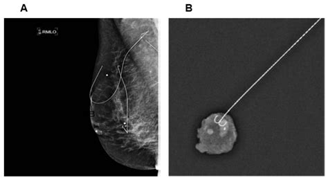 Options to Determine Pathological Response of Axillary Lymph Node