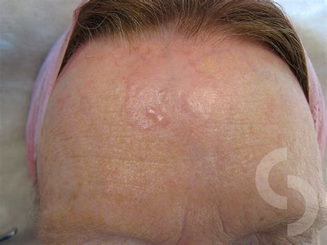 Basal Cell Carcinoma | dr Sonja Cerovac