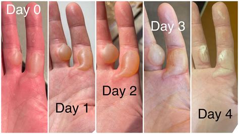 long  blisters  discover  healing time  tips marathoners