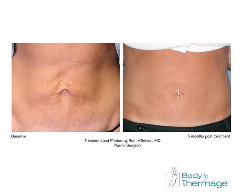 Thermage Skin Tightening - Laser Spa Group