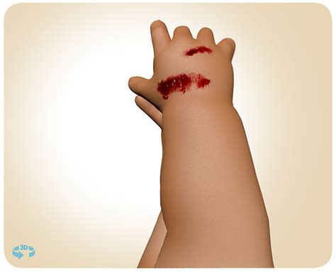 | KEDRAB Clinical Information I KEDRAB® Rabies Immune Globulin (Human)