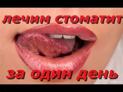 Фото Как Выглядит Стоматит