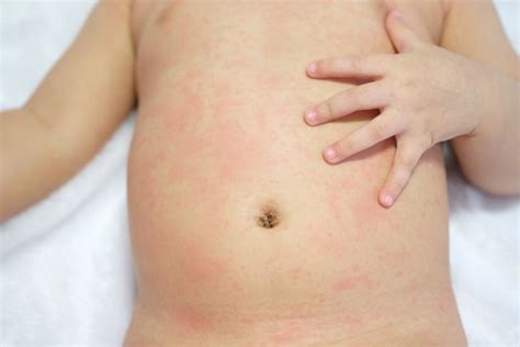 10 Symptoms and Treatments of Scarlet Fever - Facty Health
