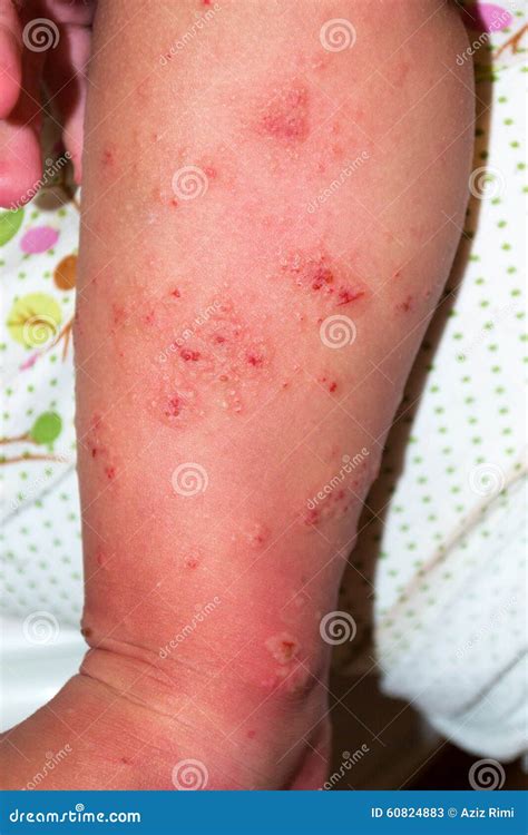 Imundo encontro ervilha scabies on legs assentamento Derivação Intestinos