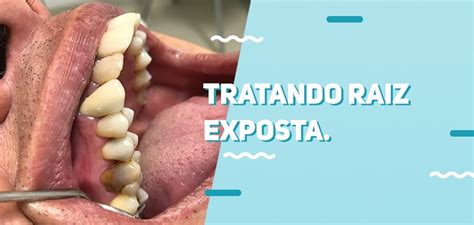 Dente Com Raiz Exposta Pode Cair - Retração Gengival: como tratar casos de raiz exposta | Ortoline ...