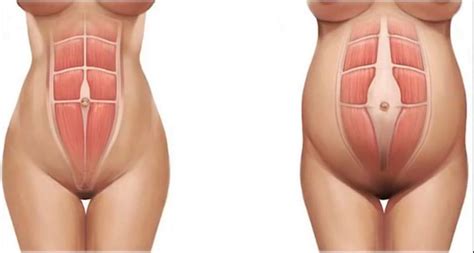 Diastase Abdominal Pos Parto - Diástasis abdominal postparto: ¡Consejos para detectarla y recuperar el ...