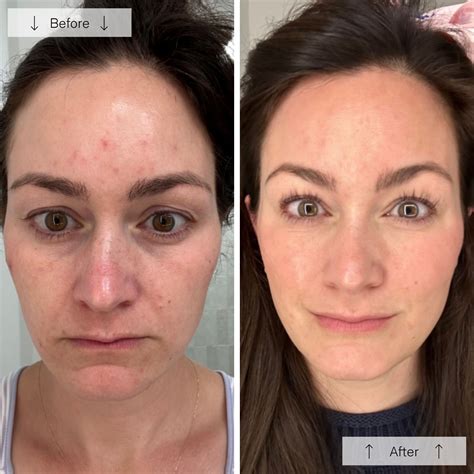 omnilux face mask 7