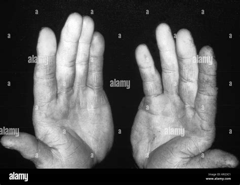 Raynauds syndrome Black and White Stock Photos & Images - Alamy