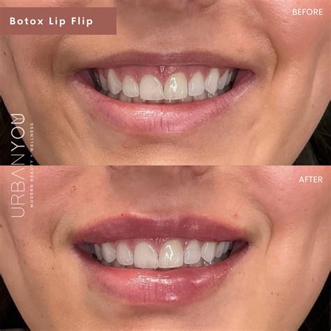 "TrapTox" - Everything you Should know about Botox in the Trapezius