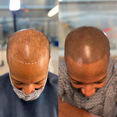Scalp Micropigmentation Before and After Photos