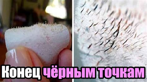 Как Избавиться от Черных Точек за 1 минуту [Быстрый Способ Избавления ...