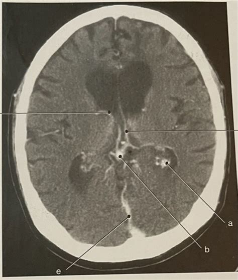 Axial CT of the brain Diagram | Quizlet