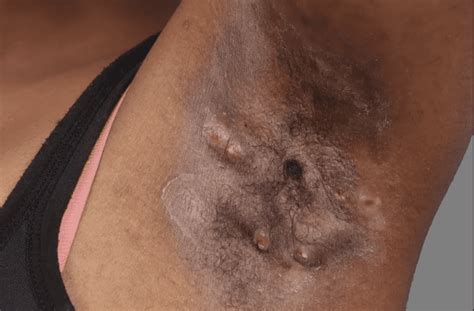 hidradenitis suppurativa hs nowincluded