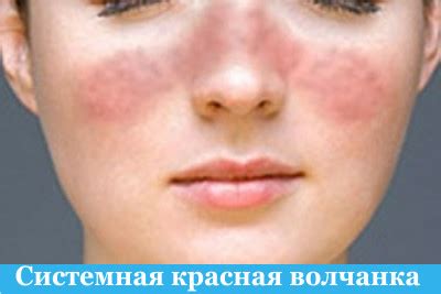 Системные заболевания соединительной ткани | РевмаКлиник