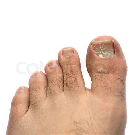 Closeup of a hairy human foot and toes with a cracked and peeling toe