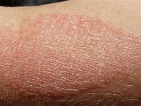 xerosis radiant clinique