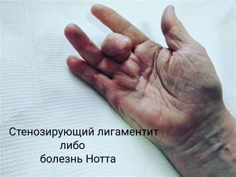 Средний палец: анатомия, особенности, переломы