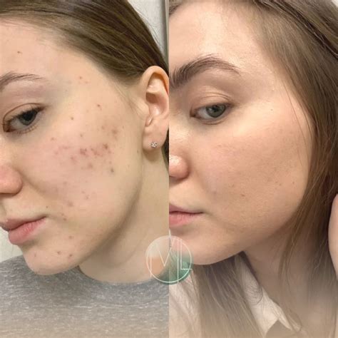 Микроигольчатый RF-Лифтинг со скидкой 30% | MED LOVE