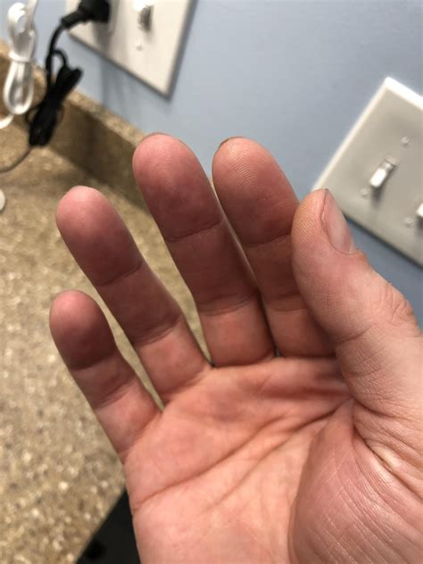 What are these small black dots that appear on my left hand fingertips