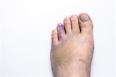 types  toe fractures blog