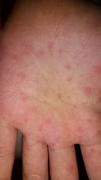 だんだん広がっているのですが、これは何の湿疹でしょうか？手のひら、... - Yahoo!知恵袋