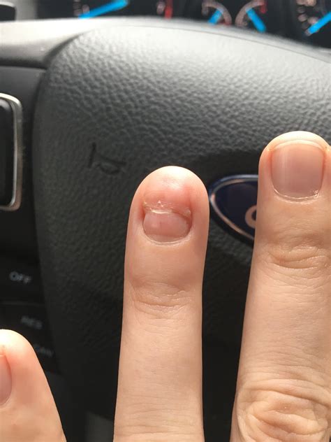 Lost my fingernail. This is ~2 months of regrowth. : r/mildlyinteresting