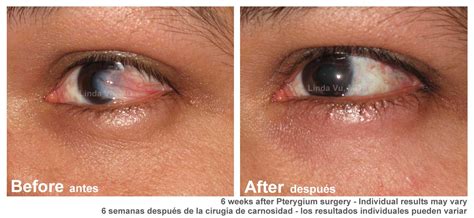 pterygium surgery    monterey park