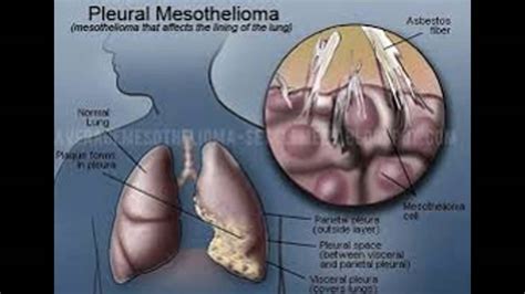 mesothelium - YouTube
