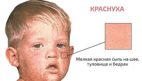 Краснуха - причины, симптомы, диагностика и лечение