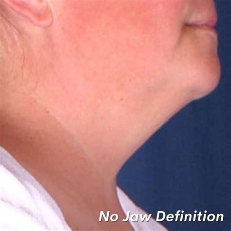 Neck Lift Alternatives: Surgical & Non-surgical Options | Omaha ...